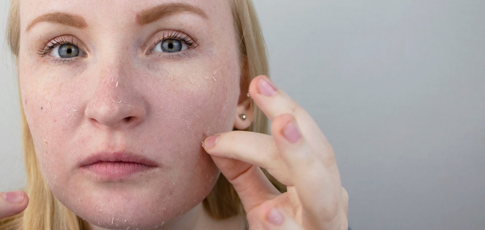 Peau sèche : décryptage et solutions pour un hiver en beauté.