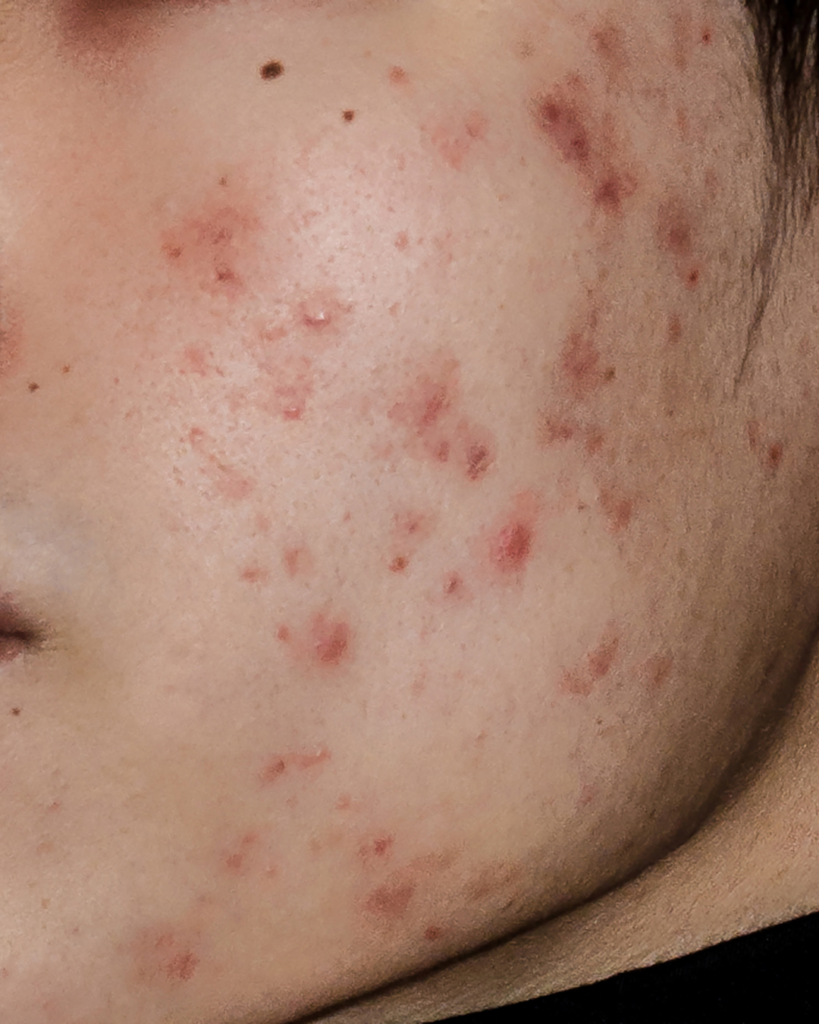 Les peaux à imperfections  : un état de peau transitoire.