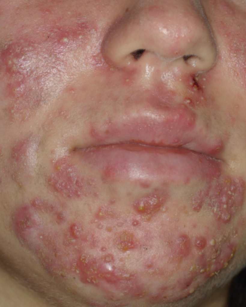 L'acné sévère doit être prise en charge par un dermatologue.