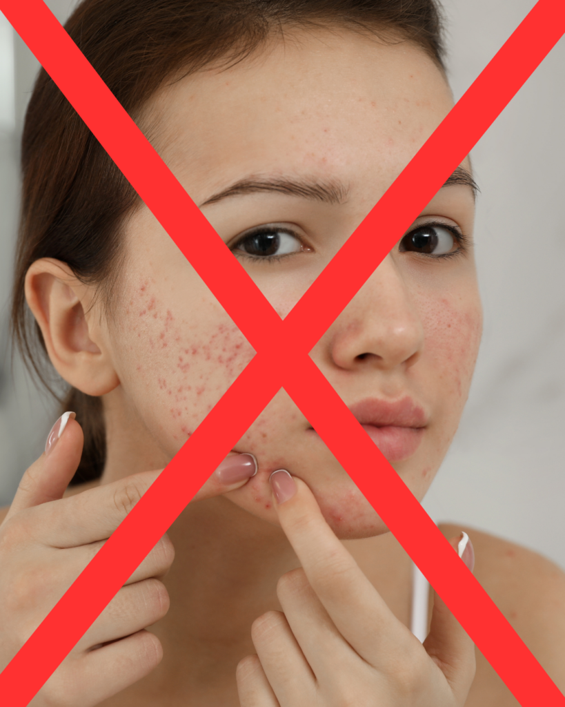 Peau acnéique : ne percez pas vos boutons