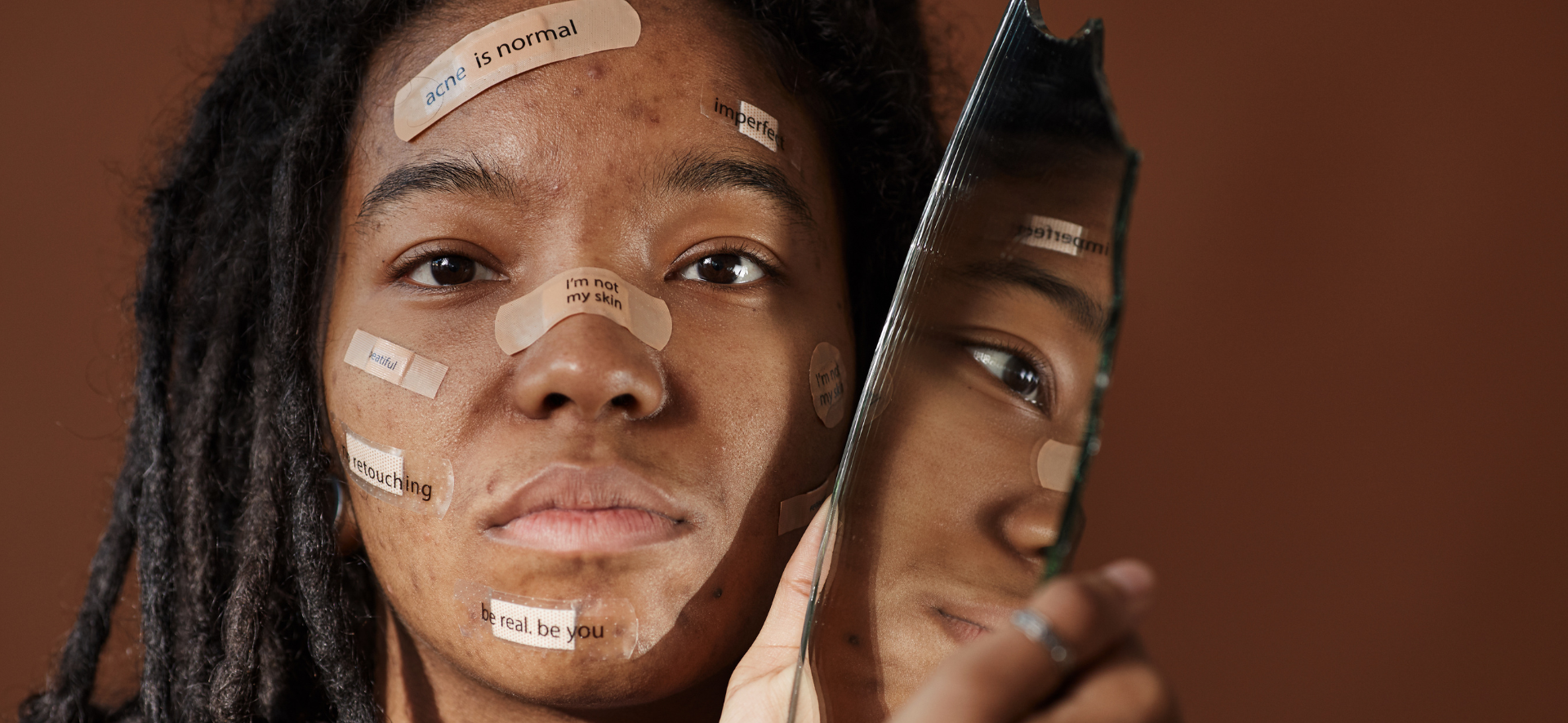 Acné : 4 étapes essentielles pour retrouver une belle peau.