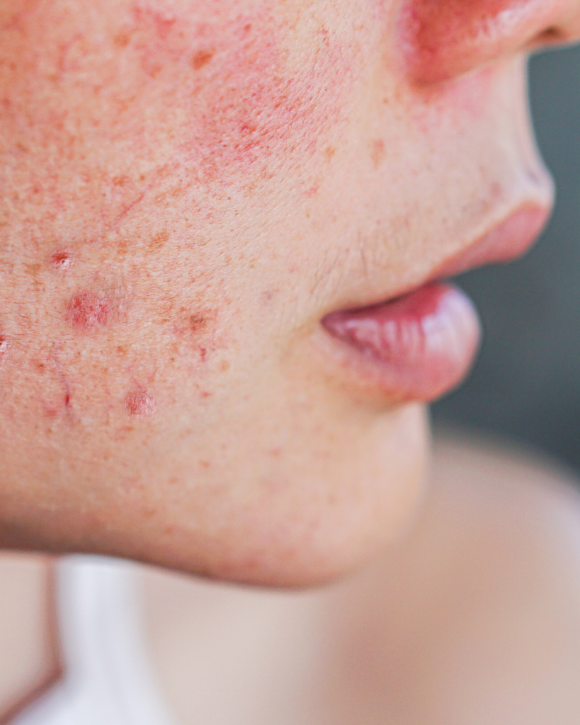 Beauty devices : l'acné
