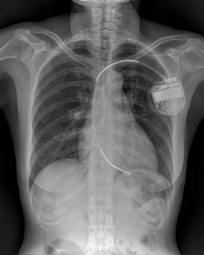 La contre-indication aux micro-courants : le pacemaker