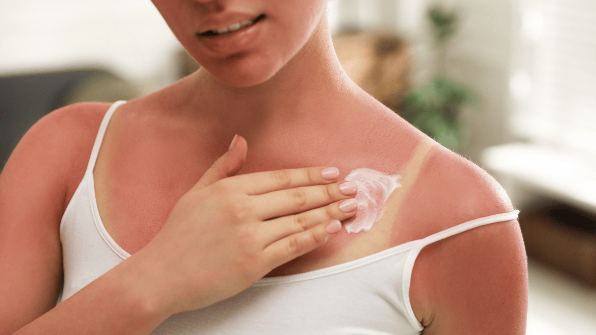 Soigner un coup de soleil efficacement : alerte épiderme brûlé !