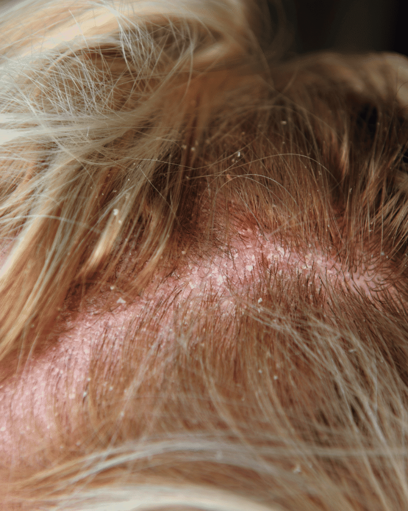 Dermatite séborrhéique du cuir chevelu.